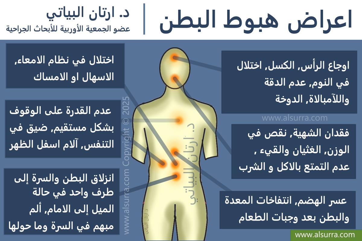اعراض هبوط البطن (شلع السرة)